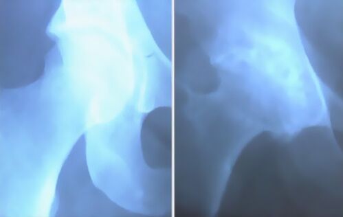 Артикуляция колена артроз